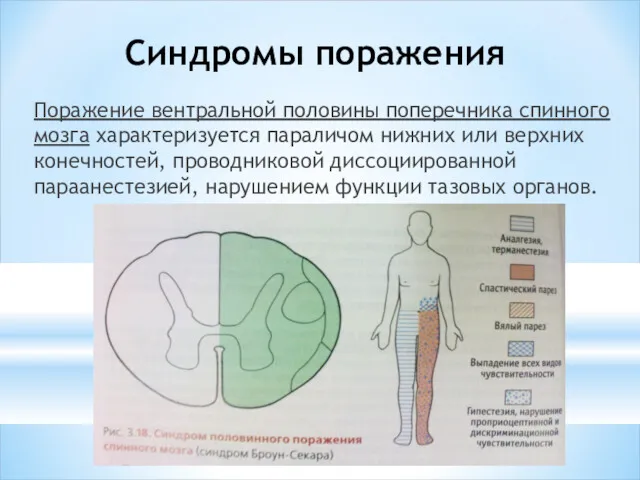 Синдромы поражения Поражение вентральной поло­вины поперечника спинного мозга характеризуется параличом