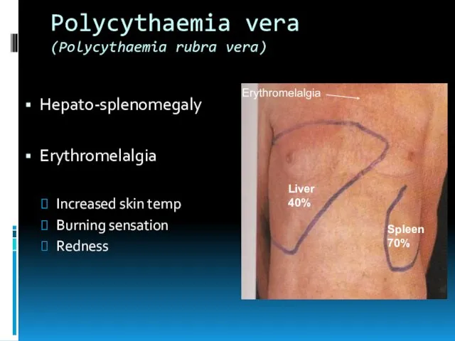 Polycythaemia vera (Polycythaemia rubra vera) Hepato-splenomegaly Erythromelalgia Increased skin temp