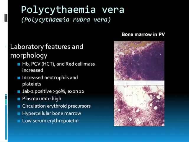 Polycythaemia vera (Polycythaemia rubra vera) Laboratory features and morphology Hb,