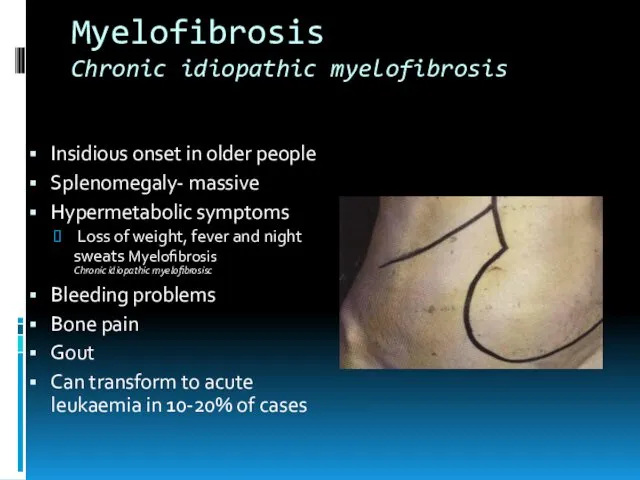 Myelofibrosis Chronic idiopathic myelofibrosis Insidious onset in older people Splenomegaly-