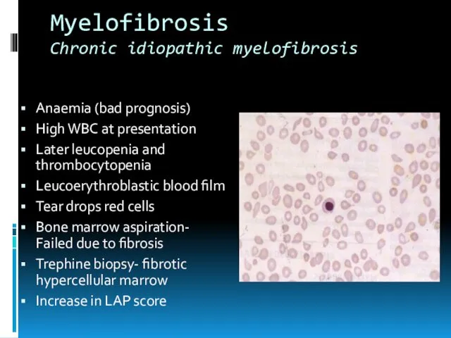 Myelofibrosis Chronic idiopathic myelofibrosis Anaemia (bad prognosis) High WBC at