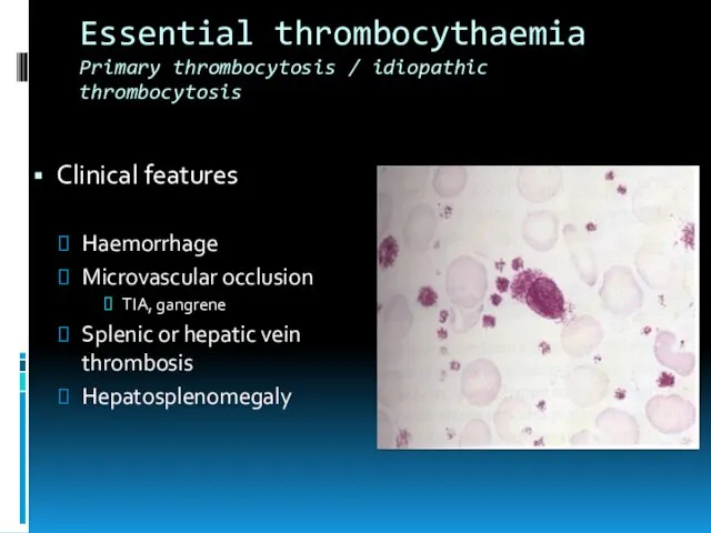 Essential thrombocythaemia Primary thrombocytosis / idiopathic thrombocytosis Clinical features Haemorrhage