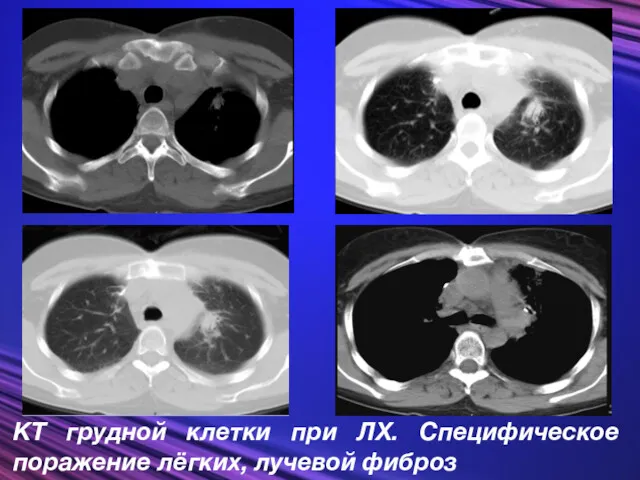 КТ грудной клетки при ЛХ. Специфическое поражение лёгких, лучевой фиброз