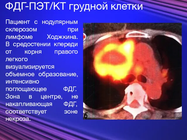 ФДГ-ПЭТ/КТ грудной клетки Пациент с нодулярным склерозом при лимфоме Ходжкина.