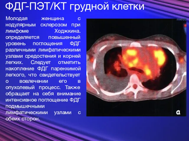 ФДГ-ПЭТ/КТ грудной клетки Молодая женщина с нодулярным склерозом при лимфоме