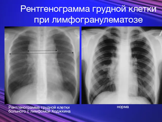 норма Рентгенограмма грудной клетки при лимфогранулематозе Рентгенограмма грудной клетки больного с лимфомой Ходжкина