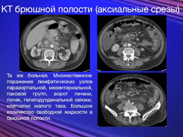 КТ брюшной полости (аксиальные срезы) Та же больная. Множественное поражение