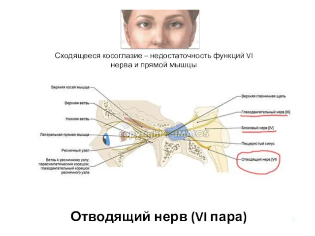 Отводящий нерв (VI пара) Сходящееся косоглазие – недостаточность функций VI нерва и прямой мышцы