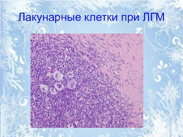 Лакунарные клетки при ЛГМ