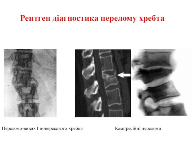 Рентген діагностика перелому хребта Переломо-вивих І поперекового хребця Компресійні переломи