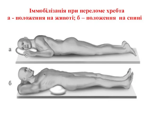 Іммобілізація при переломе хребта а - положення на животі; б – положення на спині