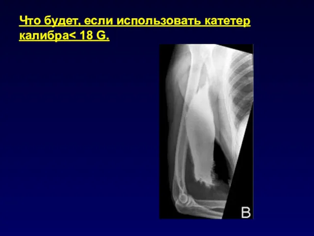 Что будет, если использовать катетер калибра