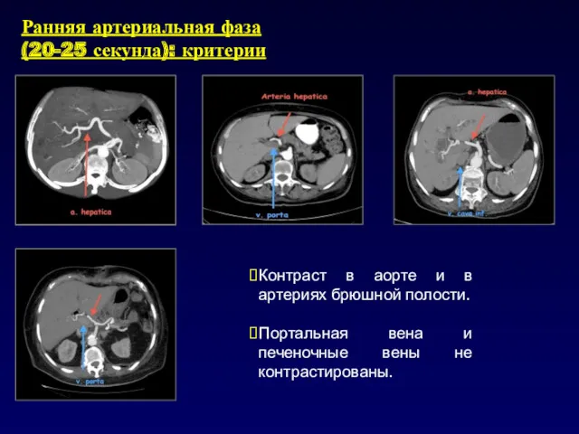 Ранняя артериальная фаза (20-25 секунда): критерии Контраст в аорте и