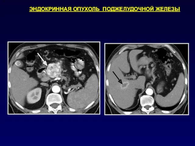 ЭНДОКРИННАЯ ОПУХОЛЬ ПОДЖЕЛУДОЧНОЙ ЖЕЛЕЗЫ