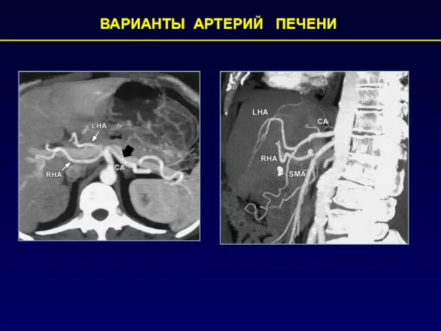 ВАРИАНТЫ АРТЕРИЙ ПЕЧЕНИ