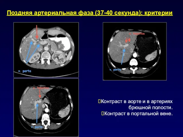 Поздняя артериальная фаза (37-40 секунда): критерии Контраст в аорте и