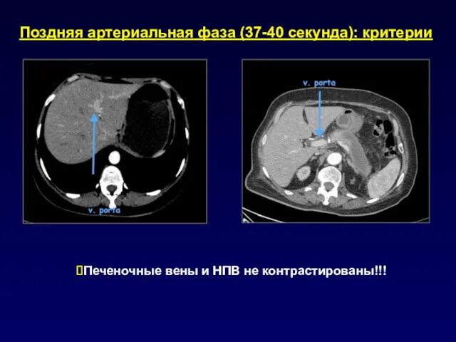 Поздняя артериальная фаза (37-40 секунда): критерии Печеночные вены и НПВ не контрастированы!!!