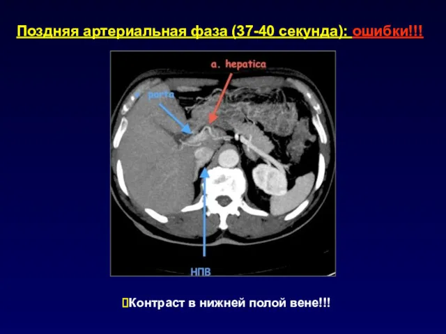 Поздняя артериальная фаза (37-40 секунда): ошибки!!! Контраст в нижней полой вене!!!