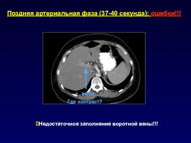 Поздняя артериальная фаза (37-40 секунда): ошибки!!! Недостаточное заполнение воротной вены!!!