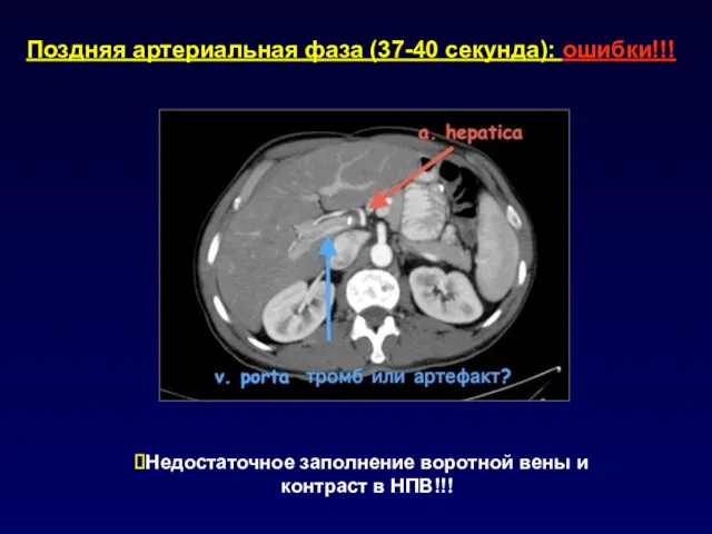 Поздняя артериальная фаза (37-40 секунда): ошибки!!! Недостаточное заполнение воротной вены и контраст в НПВ!!!