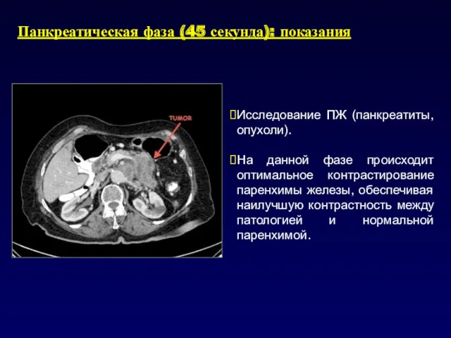 Панкреатическая фаза (45 секунда): показания Исследование ПЖ (панкреатиты, опухоли). На