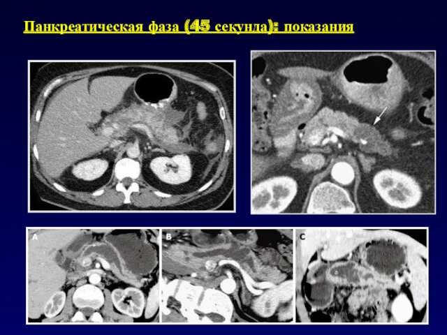 Панкреатическая фаза (45 секунда): показания