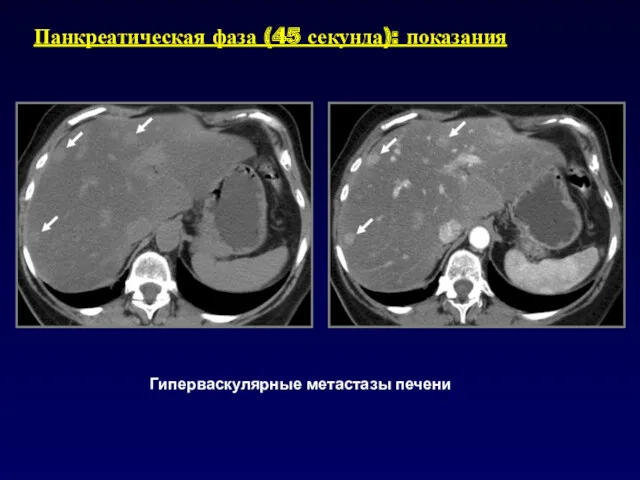 Гиперваскулярные метастазы печени Панкреатическая фаза (45 секунда): показания