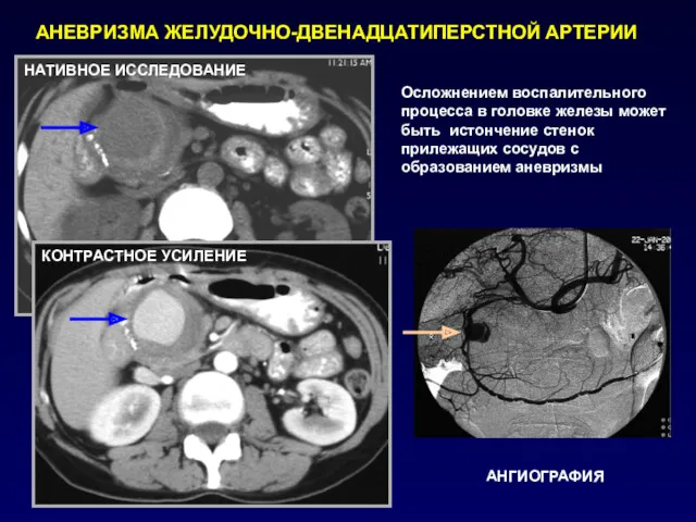 АНЕВРИЗМА ЖЕЛУДОЧНО-ДВЕНАДЦАТИПЕРСТНОЙ АРТЕРИИ Осложнением воспалительного процесса в головке железы может