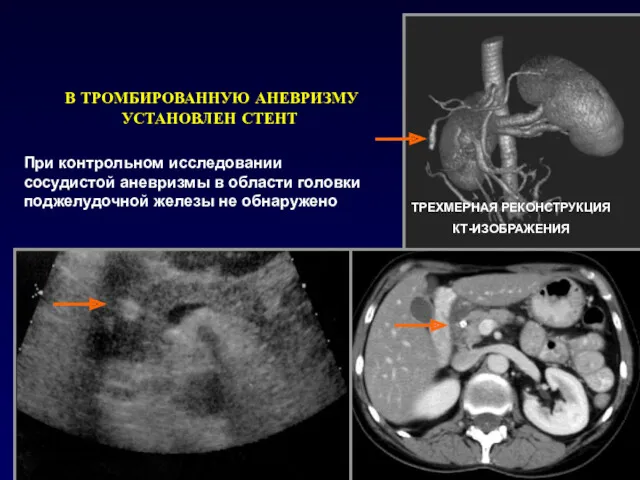 ТРЕХМЕРНАЯ РЕКОНСТРУКЦИЯ КТ-ИЗОБРАЖЕНИЯ В ТРОМБИРОВАННУЮ АНЕВРИЗМУ УСТАНОВЛЕН СТЕНТ При контрольном