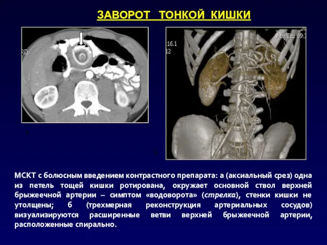 а б МСКТ с болюсным введением контрастного препарата: а (аксиальный