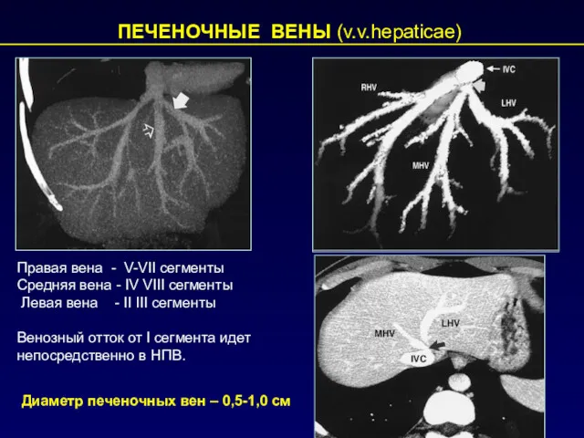 ПЕЧЕНОЧНЫЕ ВЕНЫ (v.v.hepaticae) Правая вена - V-VII сегменты Средняя вена