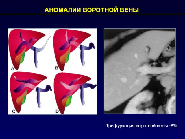 АНОМАЛИИ ВОРОТНОЙ ВЕНЫ Трифуркация воротной вены -8%