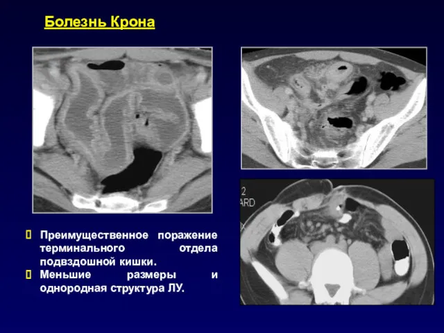 Болезнь Крона Преимущественное поражение терминального отдела подвздошной кишки. Меньшие размеры и однородная структура ЛУ.