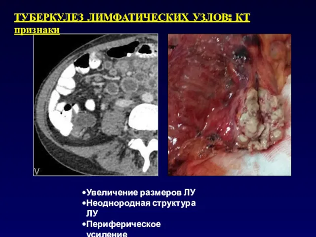 ТУБЕРКУЛЕЗ ЛИМФАТИЧЕСКИХ УЗЛОВ: КТ признаки Увеличение размеров ЛУ Неоднородная структура ЛУ Периферическое усиление
