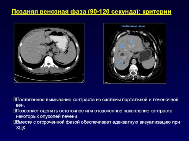 Поздняя венозная фаза (90-120 секунда): критерии Постепенное вымывание контраста из