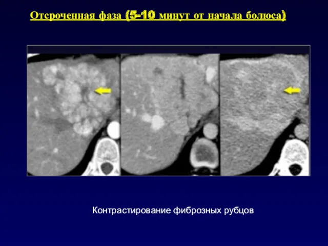 Отсроченная фаза (5-10 минут от начала болюса) Контрастирование фиброзных рубцов