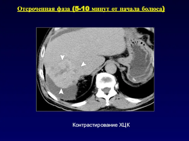 Отсроченная фаза (5-10 минут от начала болюса) Контрастирование ХЦК