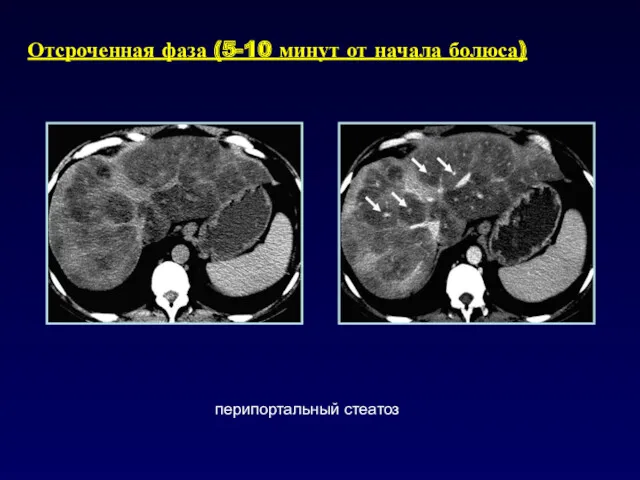 Отсроченная фаза (5-10 минут от начала болюса) перипортальный стеатоз