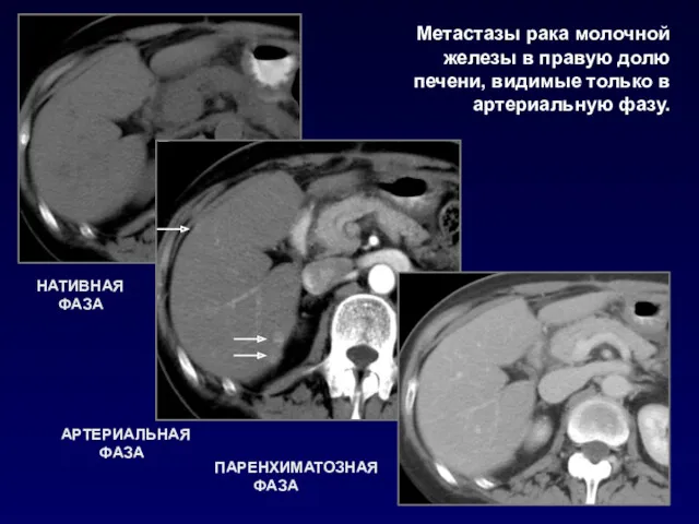 НАТИВНАЯ ФАЗА АРТЕРИАЛЬНАЯ ФАЗА ПАРЕНХИМАТОЗНАЯ ФАЗА Метастазы рака молочной железы