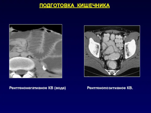 Рентгенонегативное КВ (вода) Рентгенопозитивное КВ. ПОДГОТОВКА КИШЕЧНИКА