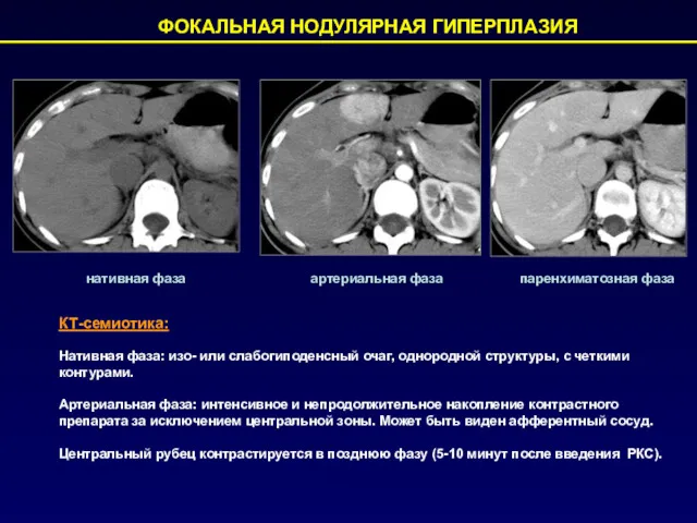 ФОКАЛЬНАЯ НОДУЛЯРНАЯ ГИПЕРПЛАЗИЯ КТ-семиотика: нативная фаза артериальная фаза Нативная фаза: