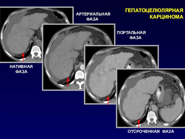 ГЕПАТОЦЕЛЮЛЯРНАЯ КАРЦИНОМА НАТИВНАЯ ФАЗА АРТЕРИАЛЬНАЯ ФАЗА ПОРТАЛЬНАЯ ФАЗА ОТСРОЧЕННАЯ ФАЗА