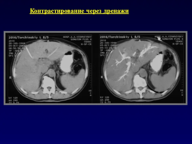 Контрастирование через дренажи