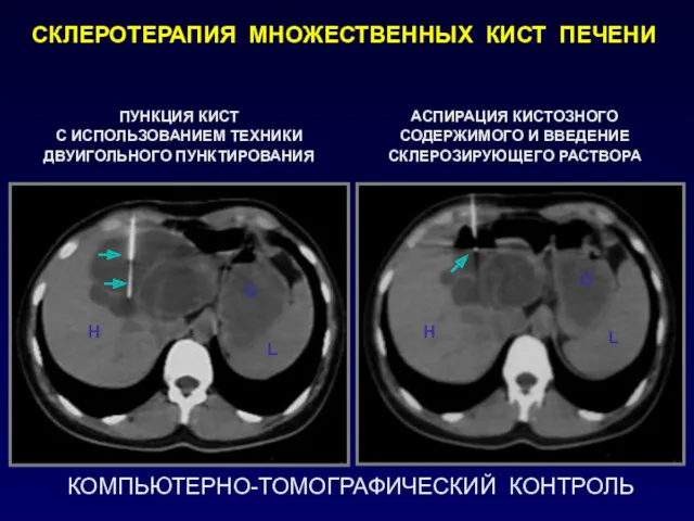 КОМПЬЮТЕРНО-ТОМОГРАФИЧЕСКИЙ КОНТРОЛЬ СКЛЕРОТЕРАПИЯ МНОЖЕСТВЕННЫХ КИСТ ПЕЧЕНИ ПУНКЦИЯ КИСТ С ИСПОЛЬЗОВАНИЕМ