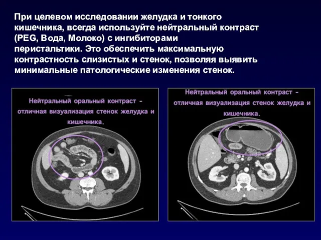 При целевом исследовании желудка и тонкого кишечника, всегда используйте нейтральный