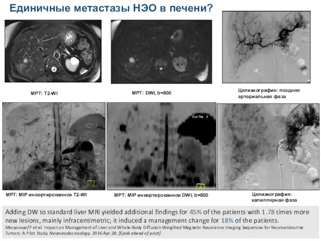 МРТ: MIP инвертированное Т2-WI МРТ: MIP инвертированное DWI, b=800 Целиакография: