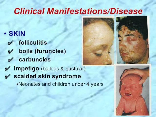 Clinical Manifestations/Disease SKIN folliculitis boils (furuncles) carbuncles impetigo (bullous &