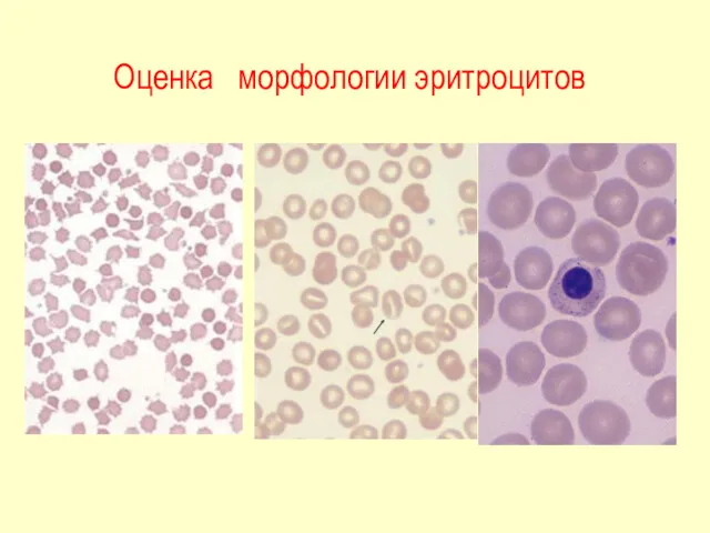 Оценка морфологии эритроцитов