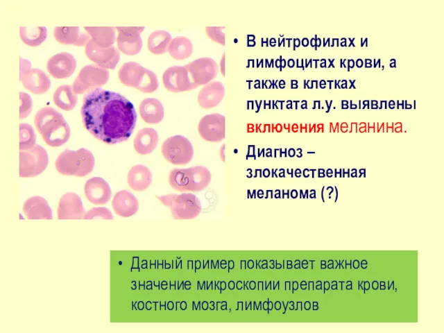 Данный пример показывает важное значение микроскопии препарата крови, костного мозга,