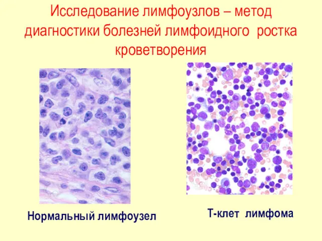 Исследование лимфоузлов – метод диагностики болезней лимфоидного ростка кроветворения Нормальный лимфоузел Т-клет лимфома